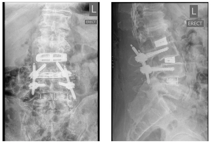 Standing front and side X-rays of the lumbar spine after surgery showing a new interbody cage with screws and rods joined to the earlier implants