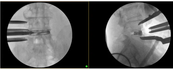 Two intraoperative fluoroscopic images of the lumbar spine showing instruments and an interbody implant at the disc space