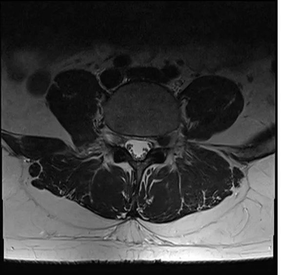 Cross-section MRI of the lower lumbar spine showing herniated disc material pressing into the spinal canal