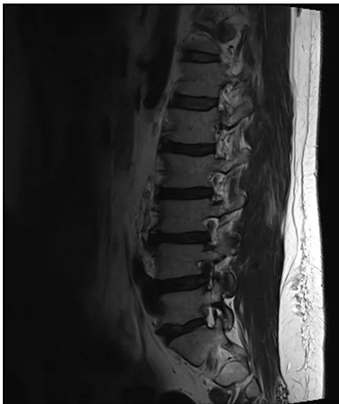 Side view MRI of the lumbar spine showing a disc herniation narrowing the spinal canal at the affected level