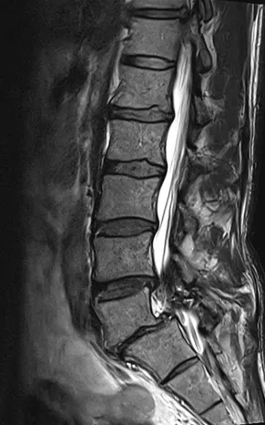 Side view MRI of the lumbar spine showing narrowing of the spinal canal at the lower lumbar levels