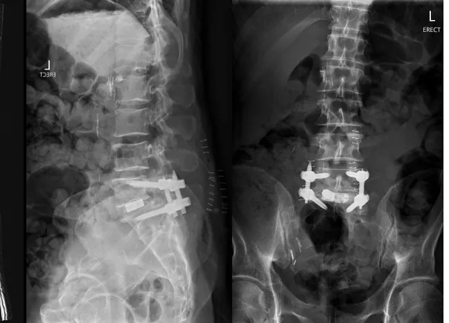 Standing side and front X-rays after surgery showing an interbody cage at L5/S1 with pedicle screws and rods